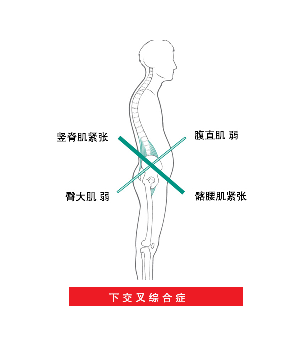 上交叉综合征及其康复训练,下交叉综合征训练方法
