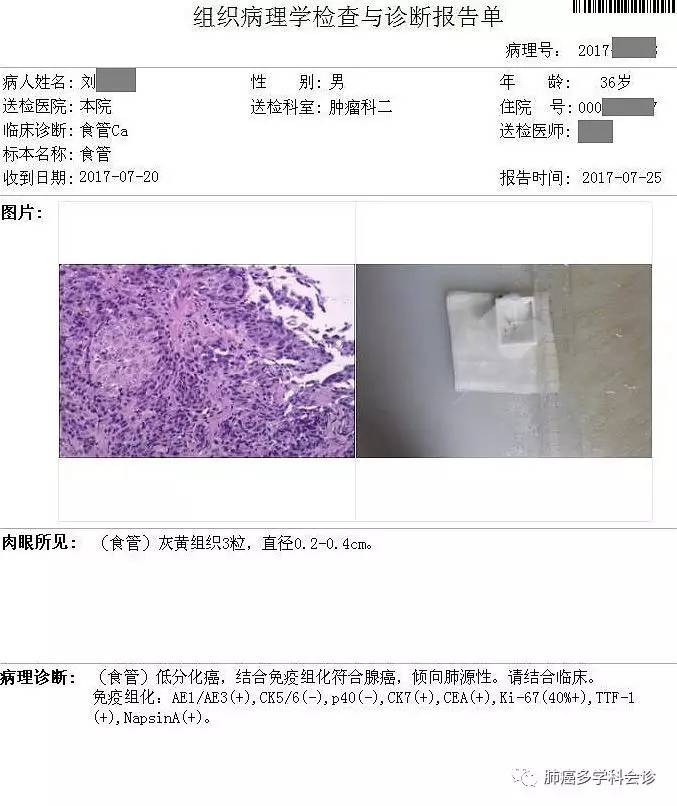 食管癌转移两侧淋巴癌严重吗,食管癌转移和扩散区别