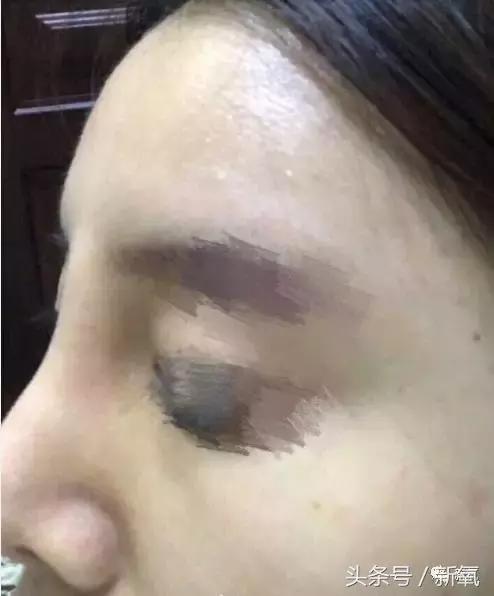 做了个达拉斯隆鼻，假体直接戳到脑门，我是不是和张檬、刘雨欣遇到了同一个医生！