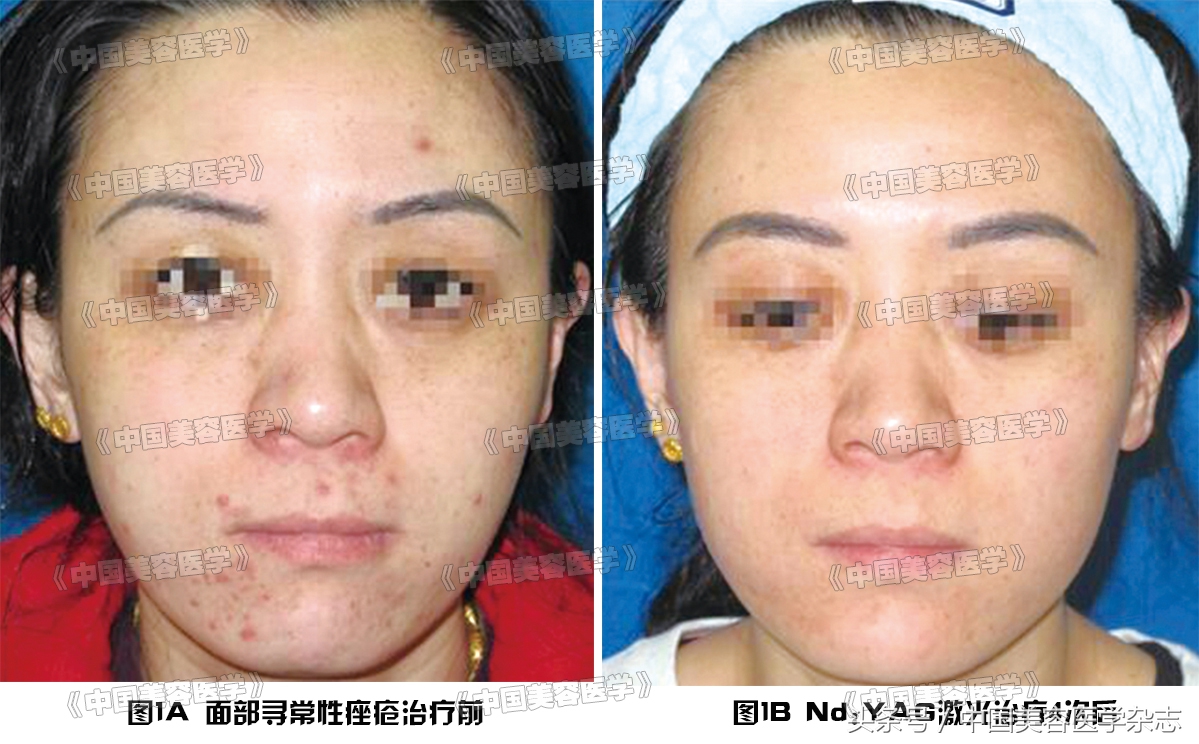 青春期痤疮中药治疗,青春期长疮怎么消除