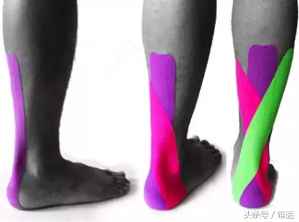 跟腱炎如何才能算是真正的好了,如果有跟腱炎应该怎么样练