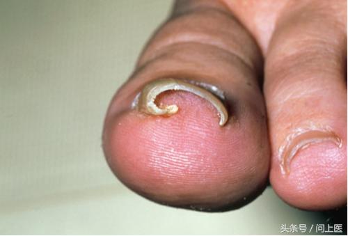 常见脚病图解最新版,各种脚病的科普视频