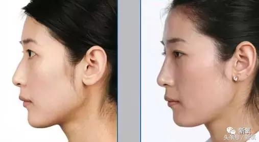 做了个达拉斯隆鼻，假体直接戳到脑门，我是不是和张檬、刘雨欣遇到了同一个医生！