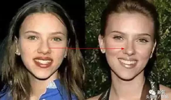 做了个达拉斯隆鼻，假体直接戳到脑门，我是不是和张檬、刘雨欣遇到了同一个医生！