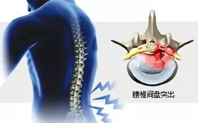 腰椎间盘突出有什么好的治疗方法,70岁老人腰椎间盘突出适合手术吗