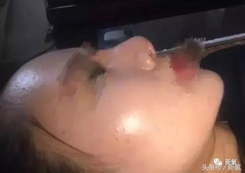 做了个达拉斯隆鼻，假体直接戳到脑门，我是不是和张檬、刘雨欣遇到了同一个医生！