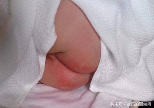 宝宝尿布疹总是反复发作怎么办,宝宝尿布疹红得厉害怎么办