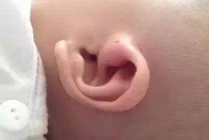 耳朵上有小洞到底有多可怕,耳朵上有个小孔后天形成