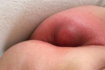 宝宝没能按时服用糖丸,小孩吃糖丸发生危险怎么回事