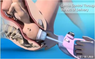顺产为啥要用胎儿吸引器,顺产用吸引器吸出胎儿