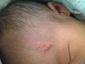 宝宝身上有5个胎记,孩子身上有10块胎记