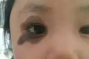 宝宝身上有5个胎记,孩子身上有10块胎记