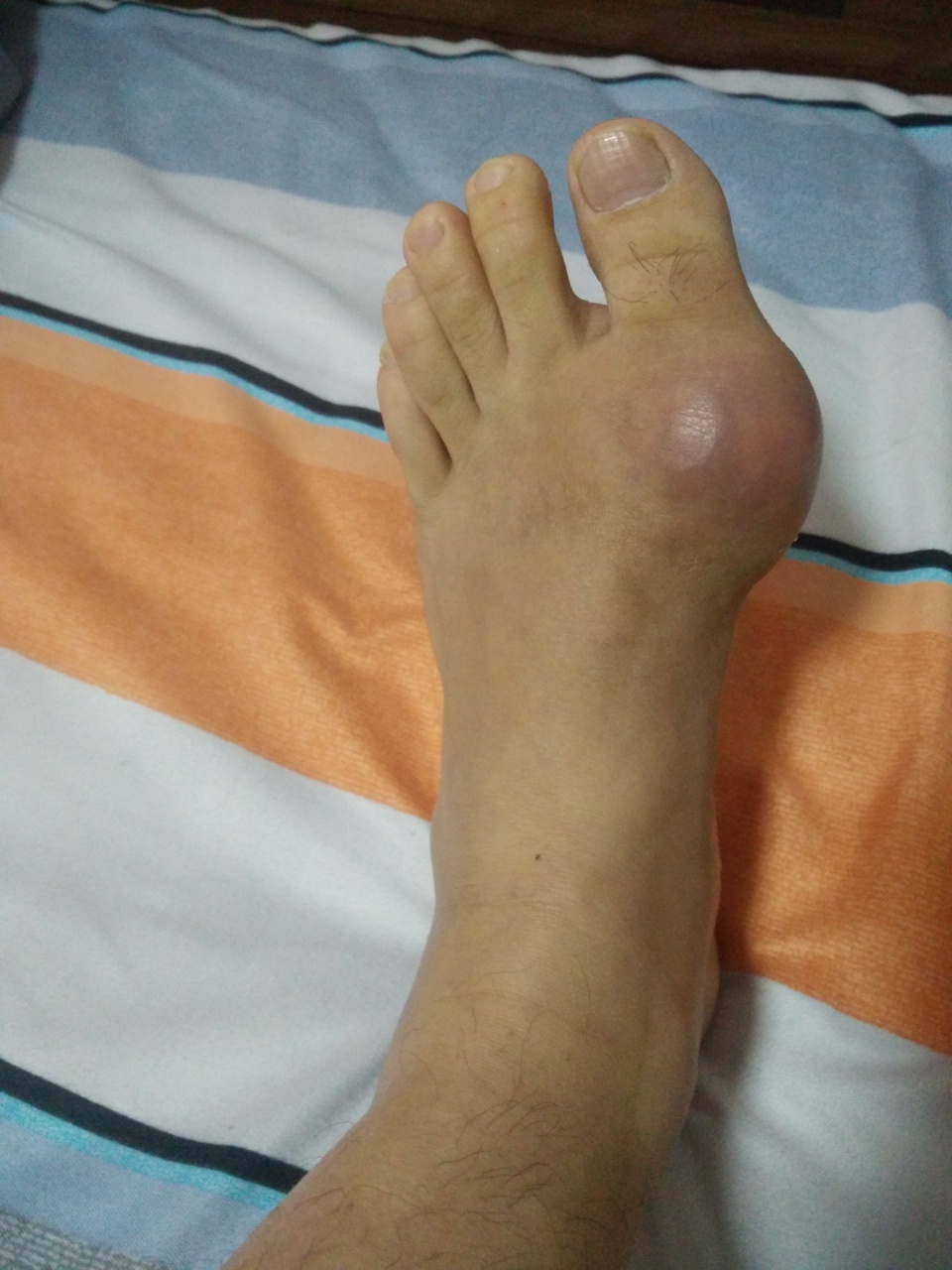 痛风还得是刚做完手术的飞哥跟你聊