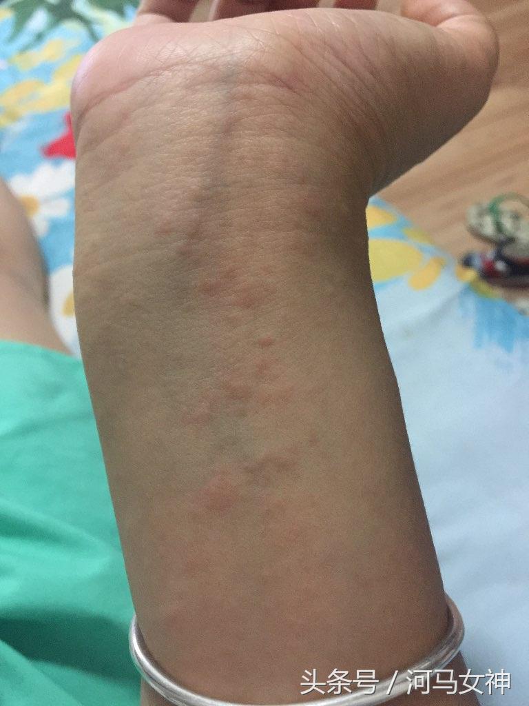 药物过敏反应抢救指南,药物过敏反应病程记录