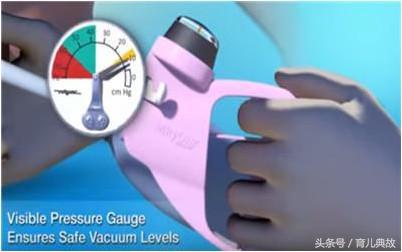 顺产为啥要用胎儿吸引器,顺产用吸引器吸出胎儿