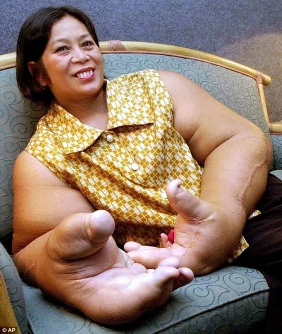 巨大的人体器官,10个人体器官最大的世界纪录