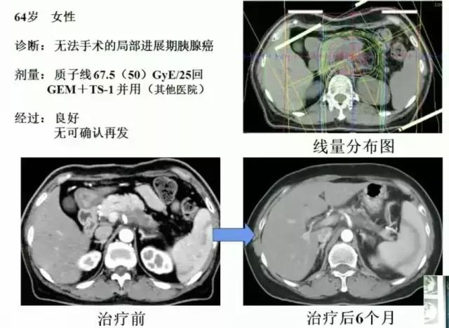 「专访」日本指宿质子中心荻野尚院长：200例胰腺癌患者经验