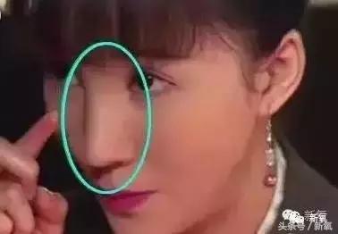 做了个达拉斯隆鼻，假体直接戳到脑门，我是不是和张檬、刘雨欣遇到了同一个医生！