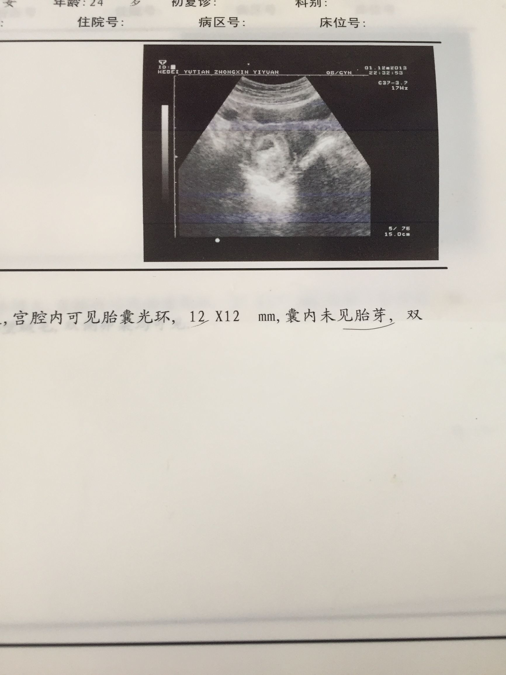 怀孕后第一次b超什么时候去做,怀孕后第一次b超应该什么时候做