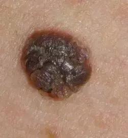 宝宝身上有5个胎记,孩子身上有10块胎记