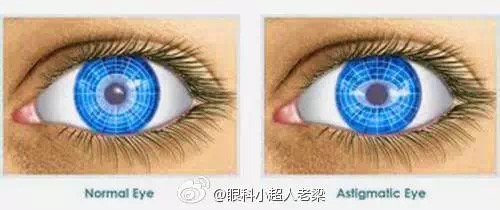 宝宝散光老母亲焦虑,孩子散光几岁治疗最好