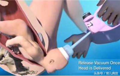 顺产为啥要用胎儿吸引器,顺产用吸引器吸出胎儿
