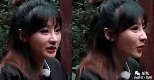 做了个达拉斯隆鼻，假体直接戳到脑门，我是不是和张檬、刘雨欣遇到了同一个医生！