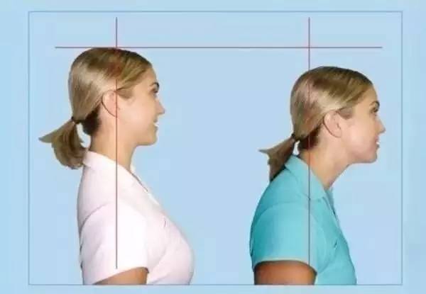 乌龟脖肿,儿童乌龟脖纠正动作