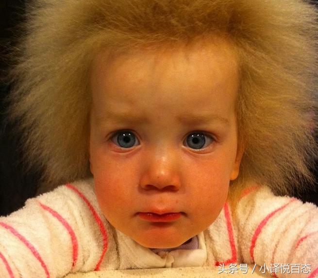 澳大利亚女性蓬发综合症,澳大利亚女孩难梳头发综合征