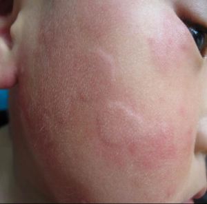 身上还痒得了荨麻疹怎么办,荨麻疹痒痒怎么缓解