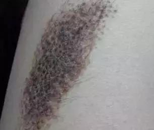 宝宝身上有5个胎记,孩子身上有10块胎记