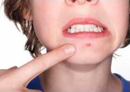 消除痘痘和痘印最简单的方法,很严重的痘痘痘印怎么消