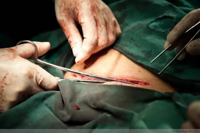 剖腹产全部流程记录,顺产剖腹产的十个真相