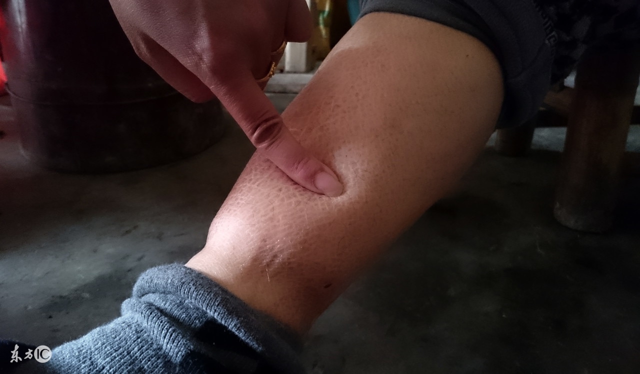 谨慎乱吃药当心导致尿毒症服药需遵医嘱不可擅自服药