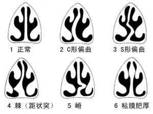 鼻中隔偏曲是什么玩意,鼻中隔偏曲有什么自愈方法吗