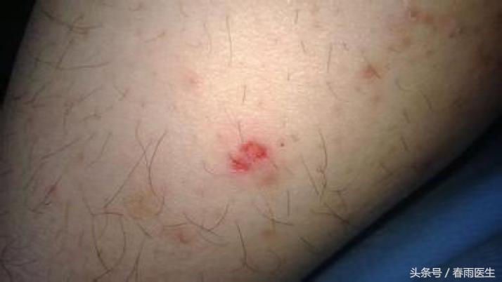 被狗咬了打了狂犬病疫苗会有事吗,被狗咬后狂犬疫苗只打一针可以吗