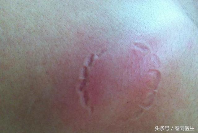 被狗咬了打了狂犬病疫苗会有事吗,被狗咬后狂犬疫苗只打一针可以吗