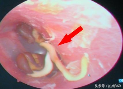 小孩把红豆塞进耳朵里面该咋办,小男孩把豆子塞耳朵里了