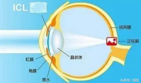 icl晶体植入最大多少度近视,icl晶体植入未来还会近视吗