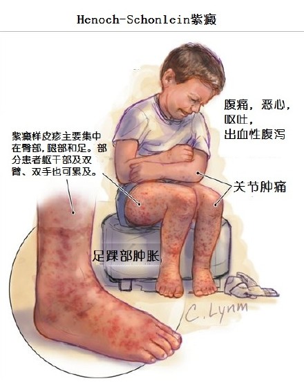 蒙医治疗过敏性紫癜100例疗效研究,雷尼替丁治疗荨麻疹的用量