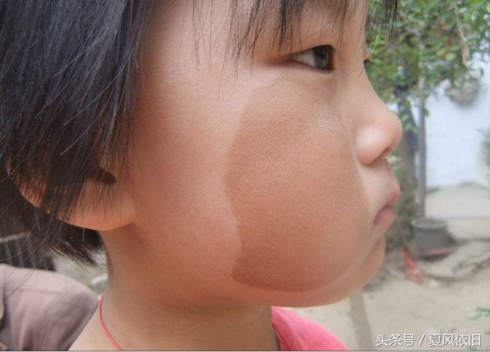 孩子有胎记一般都是怎么造成的,家长该了解胎记的五种类型