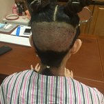 大额头适合用什么植发,大额头发际线高怎么办