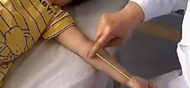 穴位埋线治湿疹多久才有效果,儿童湿疹的食疗