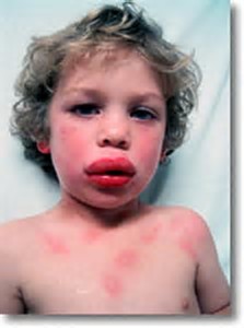 上火流鼻血能降火吗,上火流鼻血喝水管用吗