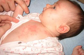 夏天起痱子最有效的解决方法,夏天痱子与秋天痱子区别