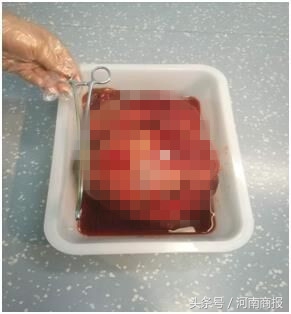 39岁女子腹中肿瘤超过30斤,女子肚子里有30斤肿瘤