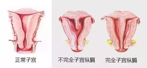 子宫不完全纵隔怀孕,做完子宫纵膈一般要多久怀孕好