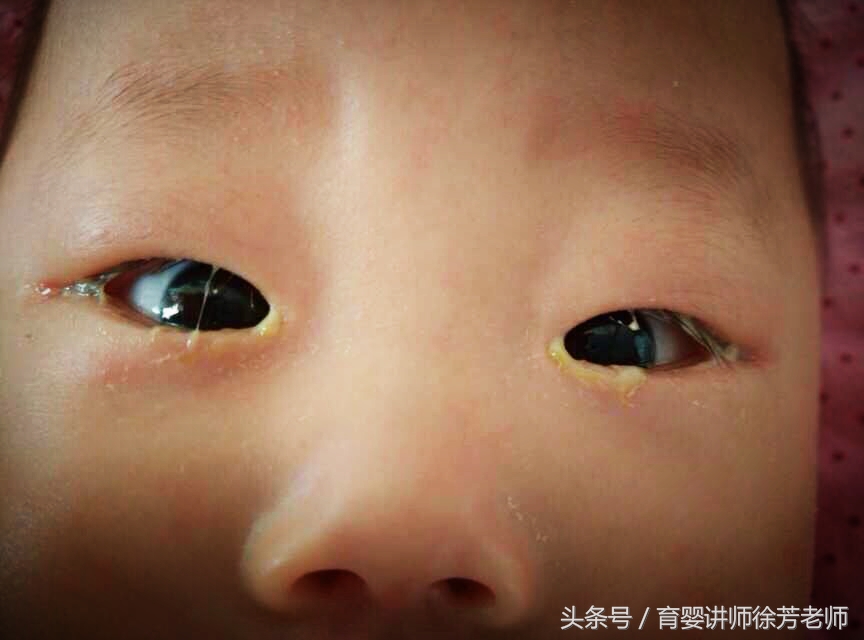 宝宝眼屎多是上火吗,宝宝眼屎多就是上火