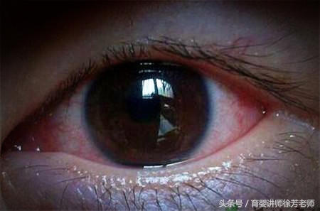 宝宝眼屎多是上火吗,宝宝眼屎多就是上火