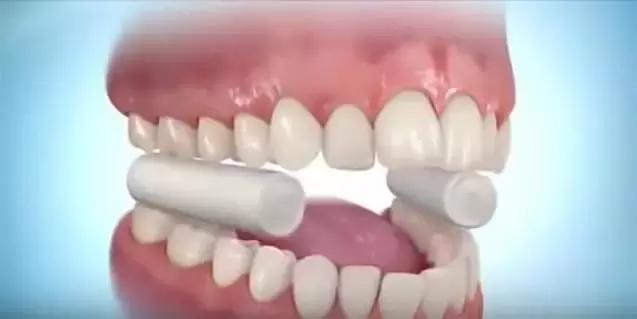 箍牙的牙套是怎么固定上去的,箍牙齿全过程图片